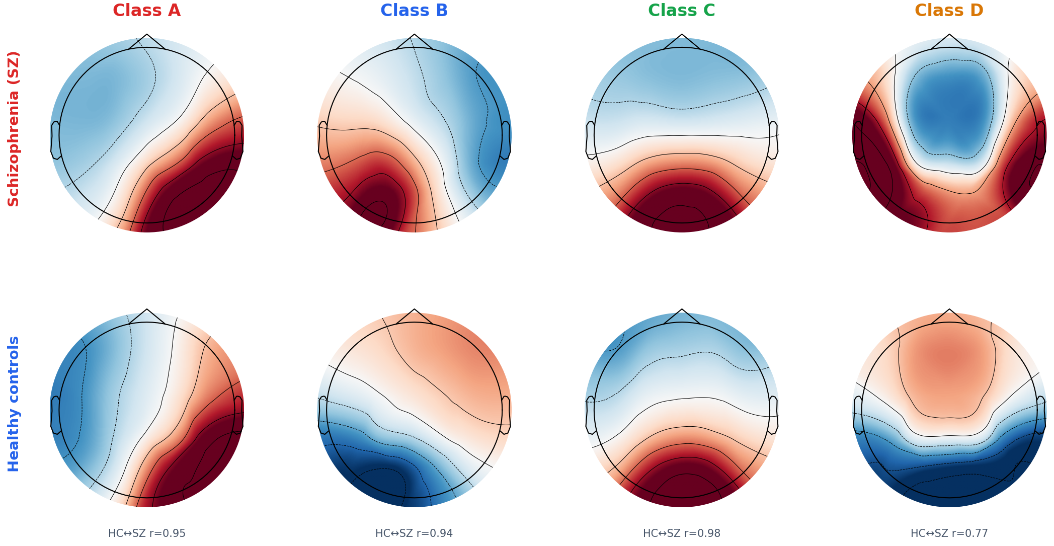 EEG microstate topographies for schizophrenia and healthy controls, classes A to D